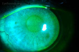 Punctate epithelial erosions