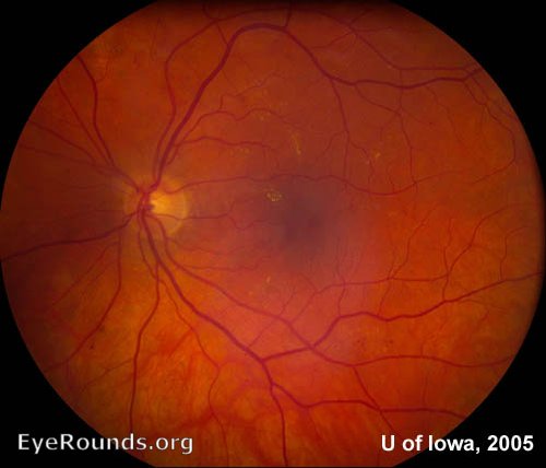 Diabetic Retinopathy, non-proliferative