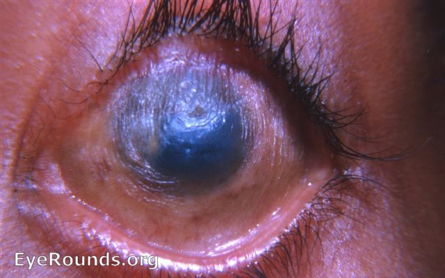 profound xerophthalmia due to vitamin A deficiency