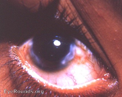 Salzmann's nodular degeneration/dystrophy- a 2nd case