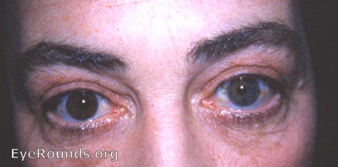 Heterochromia - no evidence of pathology
