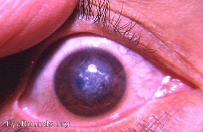 hsv disciform keratitis - calcified