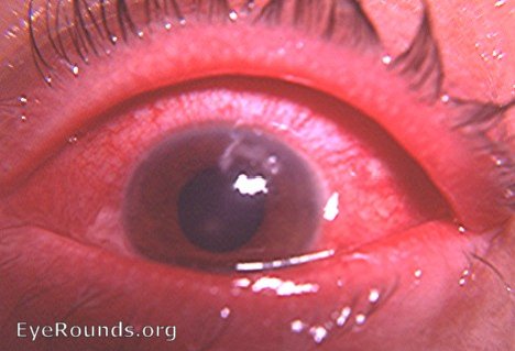 dendritic keratitis HSV - active