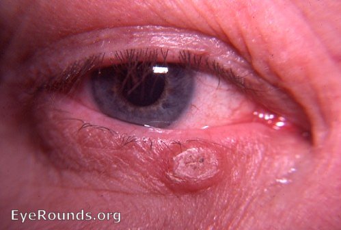 skin lesion of right lower lid;  a keratotic lesion that has become irritated