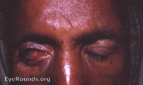 keratitis e lagophthalmos with lateral tarsorraphy