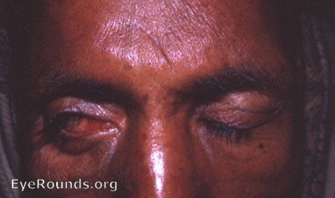 keratitis e lagophthalmos with lateral tarsorraphy