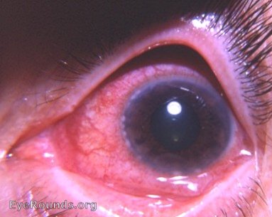 viral keratoconjunctivitis