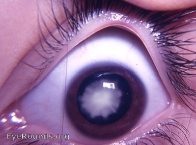 zonular cataract/ lamellar cataract