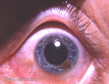 iris lesion-? leiomyoma or nevus