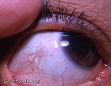 bulbar conjunctival lymph cyst