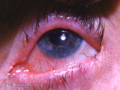 keratitis: allergic or autoimmune basis