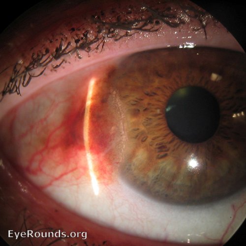 conjunctival melanoma 