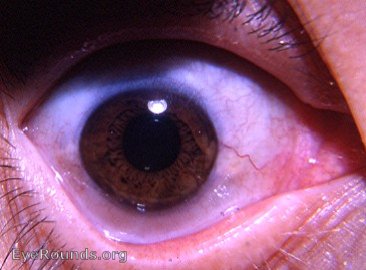cornea: aniso-cornea: microcornea OD, normal cornea OS