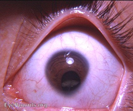 cornea: aniso-cornea: microcornea OD, normal cornea OS