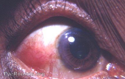 nodular episcleritis