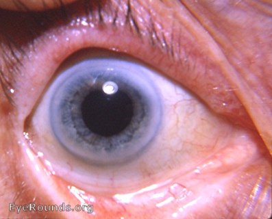 intracapsular cataract operation