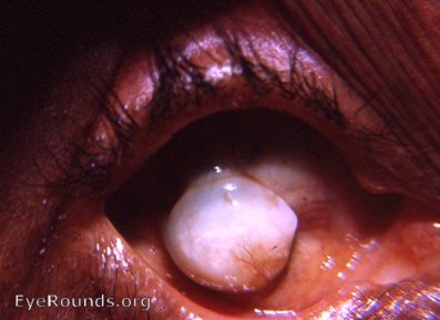 cataract: phthisis bulbi post cataract surgery