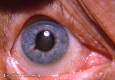 pigmented nevus of iris 