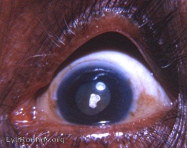 cataract-anterior polar