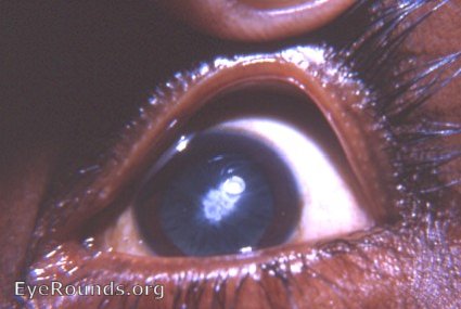 posterior polar cataract