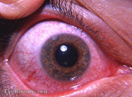 forign body - rust deposit in cornea at 7 o'clock overlying the iris frill in that region