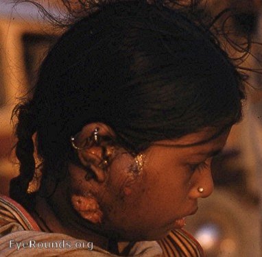 scrofula/fungating cervical tbc lymphadenitis