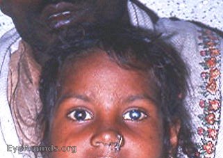 smallpox: central leukomatous corneal scar OU