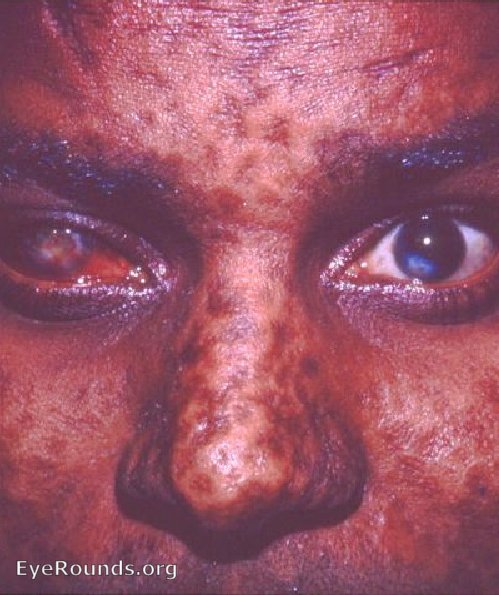 Smallpox - vascularized leukoma OD and adherent leukoma OS