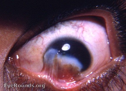 symblepharon/ pseudopterygium/ cicatricial pterygium