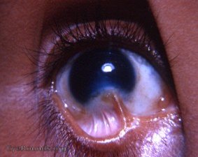 symblepharon/ pseudopterygium/ cicatricial pterygium
