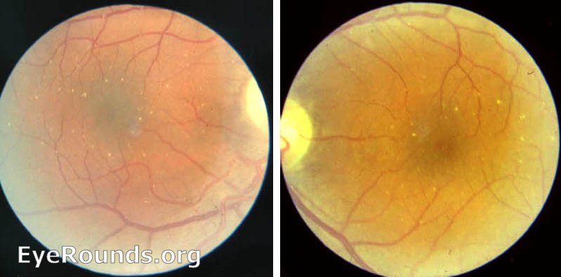 talc retinopathy