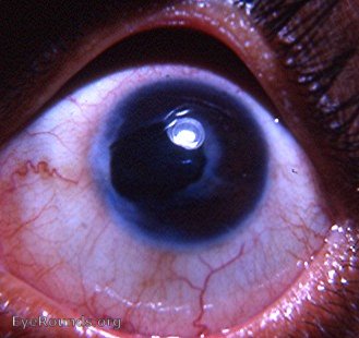 tattooing of the cornea- a part of eye history