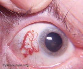 bulbar conjunctival lymph cyst