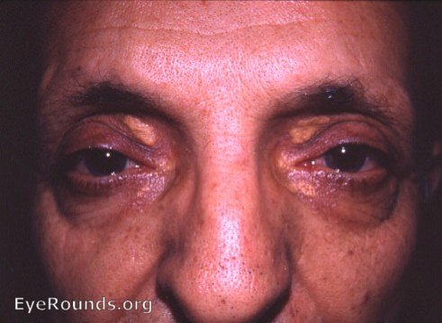 xanthoma ( xanthelasma )  of the lids