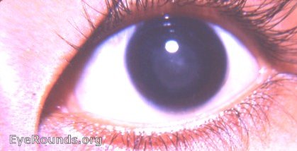 zonular cataract/ lamellar cataract