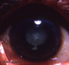 zonular/ lamellar cataract in India: computer enhanced