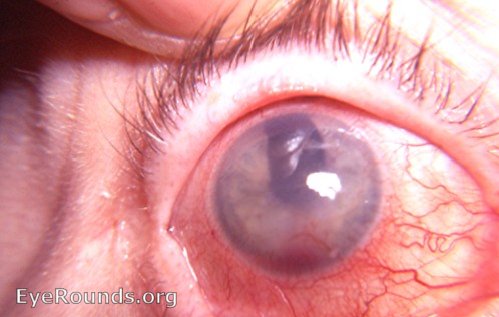 absolute glaucoma with spontaneous hyphema