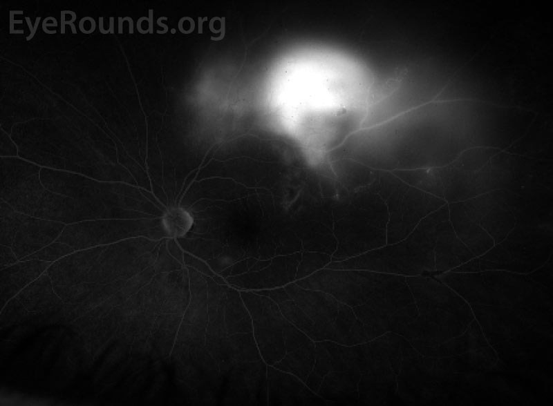 Optos widefield fluorescein angiography during the late phase shows continued superior temporal hyperfluorescence due to leakage from the neovascular vessels