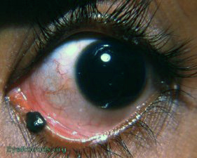pigmented lesion engulfing the inferior punctum lacrimalis