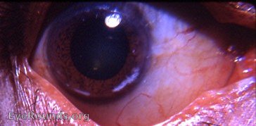 atypically located limbal girdle