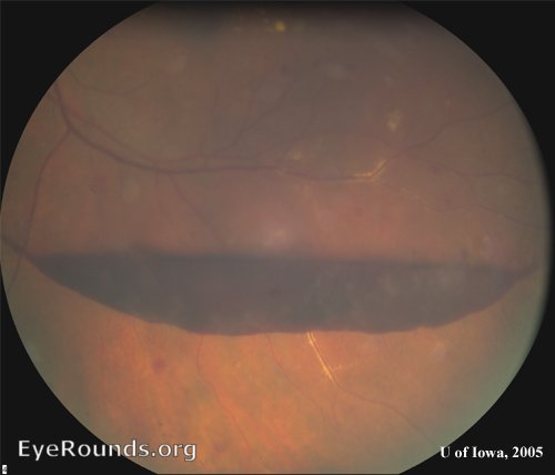 Diabetic Retinopathy  