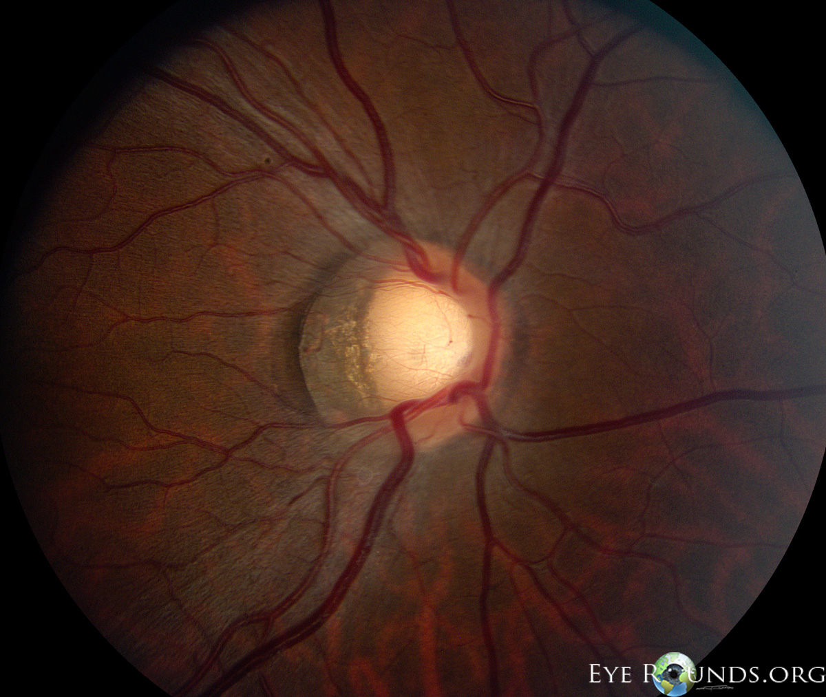 Atlas Entry Gray crescent of the optic nerve head