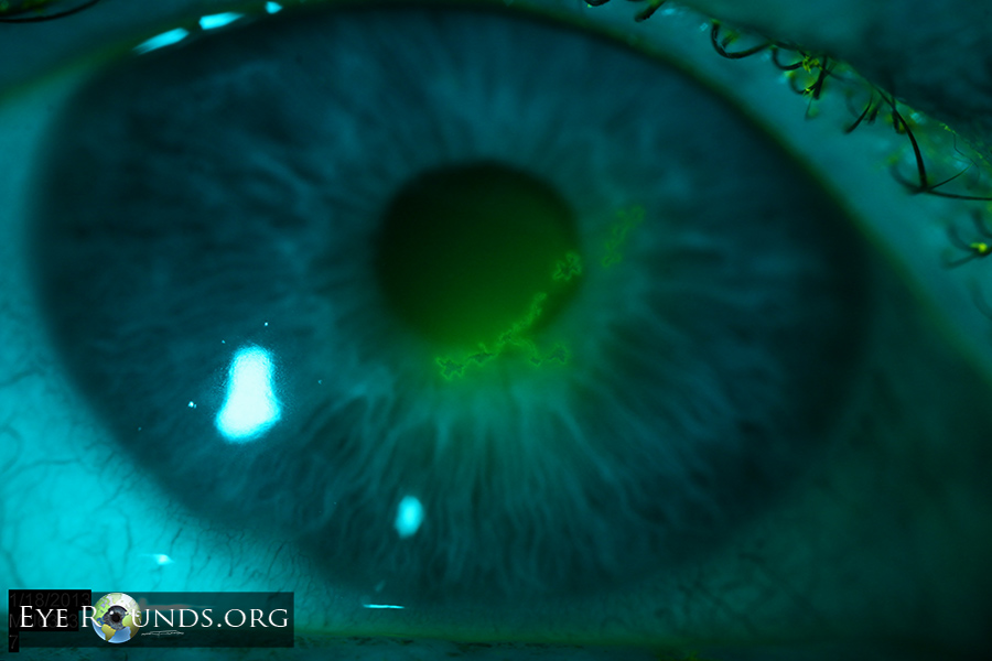 Atlas Entry Herpes Simplex Virus (HSV) epithelial keratitis