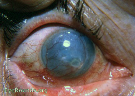 metaherpetic  HSV keratitis