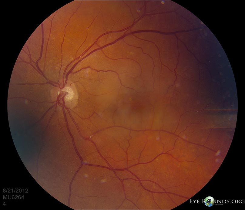 Atlas Entry Hollenhorst plaque in Branch Retinal Artery Occlusion (BRAO)