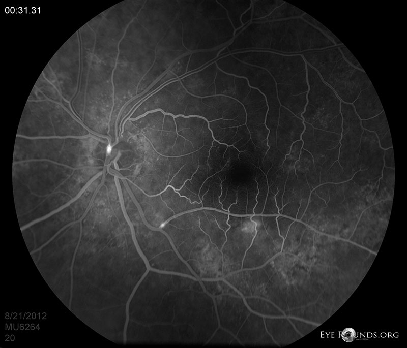 Atlas Entry Hollenhorst plaque in Branch Retinal Artery Occlusion (BRAO)