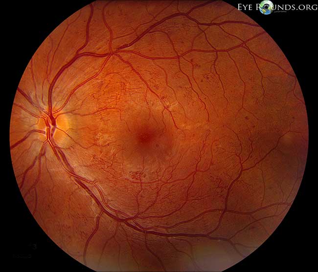 Intraretinal microvascular abnormality