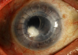 Infectious crystalline keratopathy