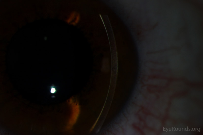 KayserFleischer Ring in Wilson's Disease