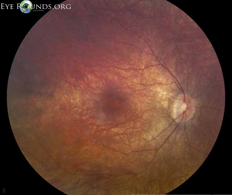 Atlas Entry Leber Congenital Amaurosis, RPE65associated